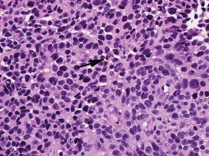 Sheets and cords of malignant melanocytes scattered throughout the lamina propria (hematoxylin and eosin, 100) Fig. 20 Amelanotic melanoma exhibiting only focal pigmentation (arrow).
