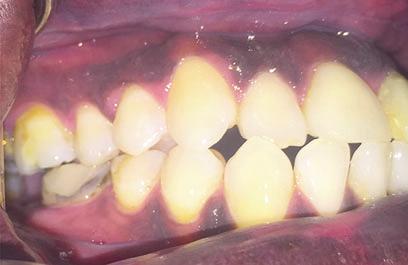 Pigmented Lesions of the Oral Mucosa 15 Fig. 22 Physiologic pigmentation of the maxillary and mandibular gingiva Fig.
