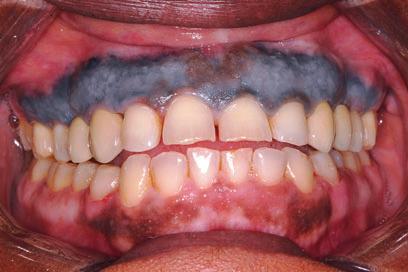 16 E.T. Stoopler and F. Alawi Fig. 25 Extensive gray/black coloration of the maxillary labial attached gingiva as a result of intraoral cosmetic tattooing.