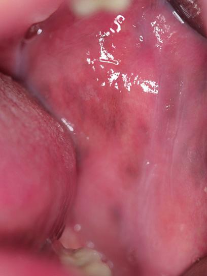 Pigmented Lesions of the Oral Mucosa 17 Etiology Polycyclic amines, such as nicotine and benzopyrene, are chemical compounds in tobacco smoke that have demonstrated the ability to stimulate
