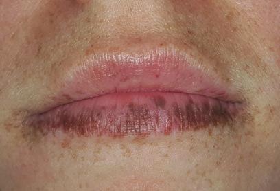 Pigmented Lesions of the Oral Mucosa 25 Fig. 32 Perioral melanosis associated with Peutz-Jeghers syndrome known STK11 mutations; the genetic cause of these patients disease remains undetermined.