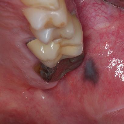 Pigmented Lesions of the Oral Mucosa 27 Fig.