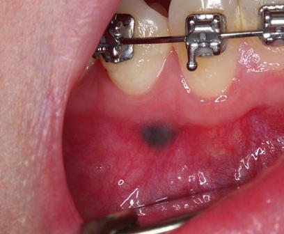 Lesion was remnant from heavily restored primary dentition (Photo courtesy:  37 Biopsy-proven graphite tattoo in a 63-year-old female