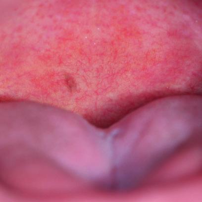 Clinical-Pathologic Features Oral/labial melanotic macules are solitary, wellcircumscribed lesions that are typically less than 1 cm in diameter (Alawi 2013; Kauzman et al. 2004).