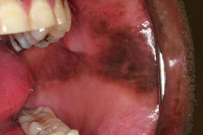 6 E.T. Stoopler and F. Alawi Fig. 7 Oral melanoacanthoma affecting the buccal mucosa Fig.