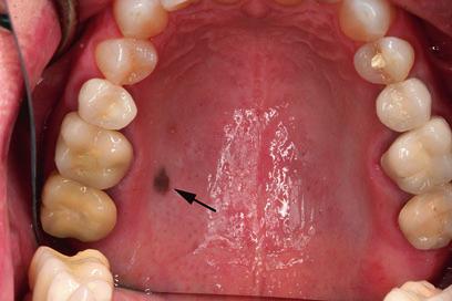 Pigmented Lesions of the Oral Mucosa 7 develop due to melanocytic growth and proliferation (Alawi 2013; Hatch 2005).