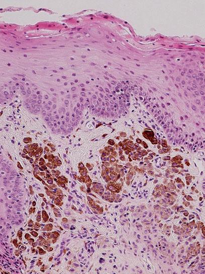 Nests of benign nevus cells are identified within the lamina propria (hematoxylin and eosin, 200) important to note that up to 15% of oral nevi may not exhibit any evidence of clinical pigmentation