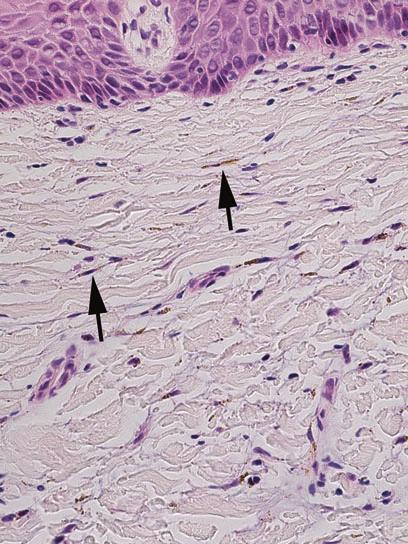 Pigmented Lesions of the Oral Mucosa 9 Fig. 13 Blue nevus.