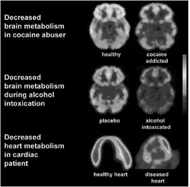 DEFINITIONS Addiction is a primary, chronic disease of brain reward, motivation, memory and related circuitry.
