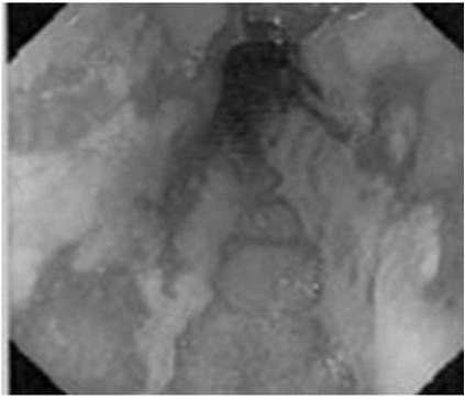 5-15% of all cases of upper GI bleeding In alcoholism, related to increased gastric pressure from repeated retching