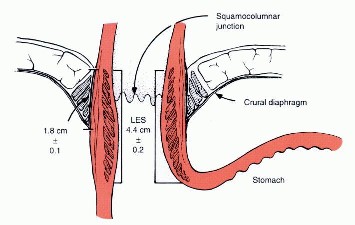 Lower Esophageal Sphincter