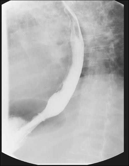 Figure 2 B: Barium esophagram shows no features of achalasia. Table 2 Bolus transit for liquid and viscous swallows in patients with MMA.