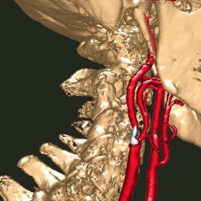 Carotid Artery Atherosclerosis Accounts for about 11% of TIAs.