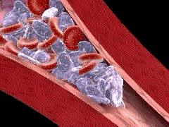 platelets Platelet & thrombus emboli TxA