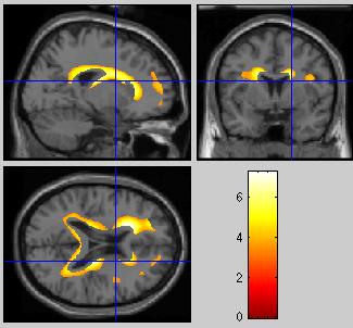 Regions showing age-related decreases in white matter volume CONTROLS ARTHRITIS Controls also
