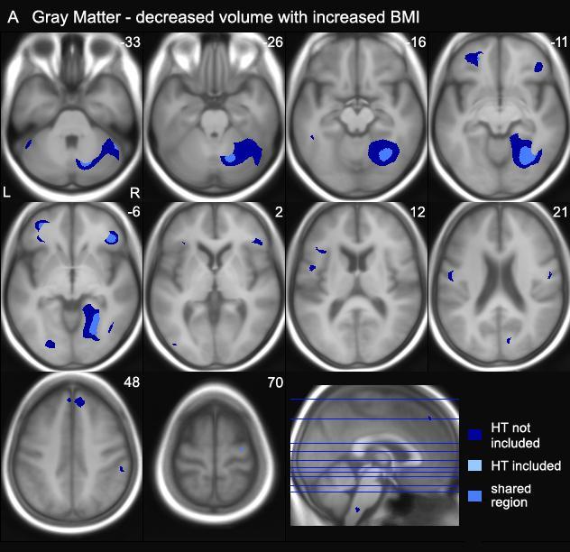 Regions of gray matter show volume decreases as