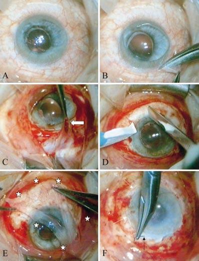 Amniotic membrane transplantation for partial limbal stem cell deficiency 569 Figure 1 Intraoperative steps of amniotic membrane transplantation (AMT).