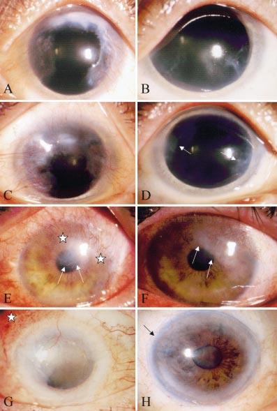 570 Anderson, Ellies, Pires, et al Figure 2 Comparison of preoperative (left panels) and postoperative (right panels) corneal appearance following AMT.