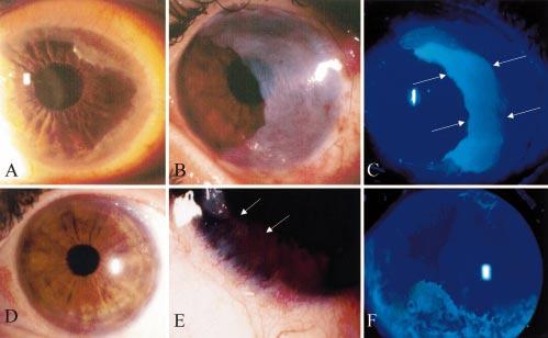 Amniotic membrane transplantation for partial limbal stem cell deficiency 571 female with a mean age of 42.3 (4.6) years (Table 1). The extent of the LSCD involved from 90 to nearly 360 of the limbus.