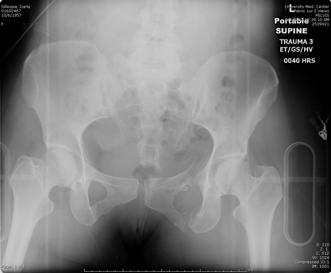 Case: Pelvic Fracture Hemodynamic Instability 49 yo woman, MCC versus car Arrival 0030 hrs Field hypotension, A, A OR x 3 BP on arrival: 80/50 FAST: