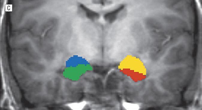 Brain abnormalities associated with long-term heavy cannabis use Hippocampus Amygdala L (yellow) and R (blue) amygdala L(red) and R(green) hippocampus morphology and function of hippocampus has been