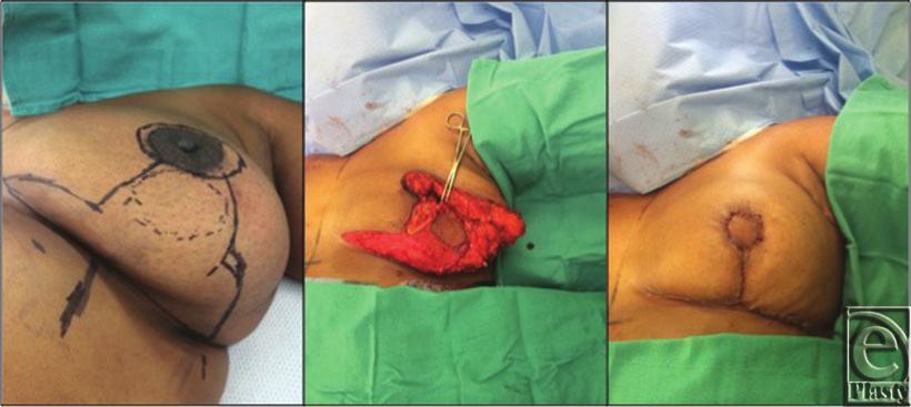 Wise-pattern mastopexy with inferior L-shaped pedicle with 6-cm vertical limbs, and plication of the dermal pedicle to 6 cm to match