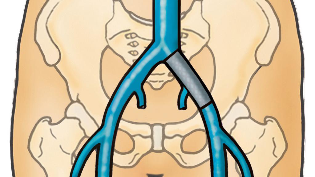 What is pelvic venous stenting? Frequently there is a narrowing in the vein which has contributed to the formation of the clot.