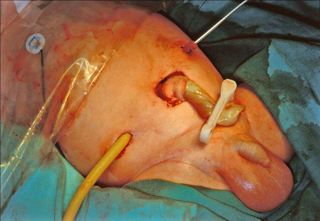 tube-jejunostomy tube-colostomy jejunal effluent is drip-fed down the distal stoma to develop the available distal bowel progressive clamping of the tube-jejunostomy increases mucosal contact, create