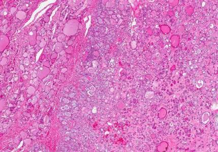 Case of an Encapsulated Follicular Patterned