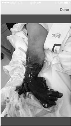 Grade 3 D ulcers Osteomyelitis Hindfoot and leg osteomyelitis is often met with few options for salvage Often move into a major amputation BKA/AKA Limb