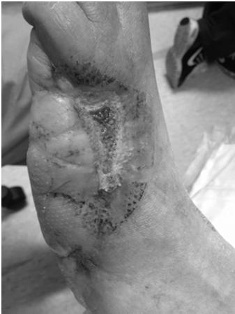 Amputation Healing Transfer Lesion Abnormal