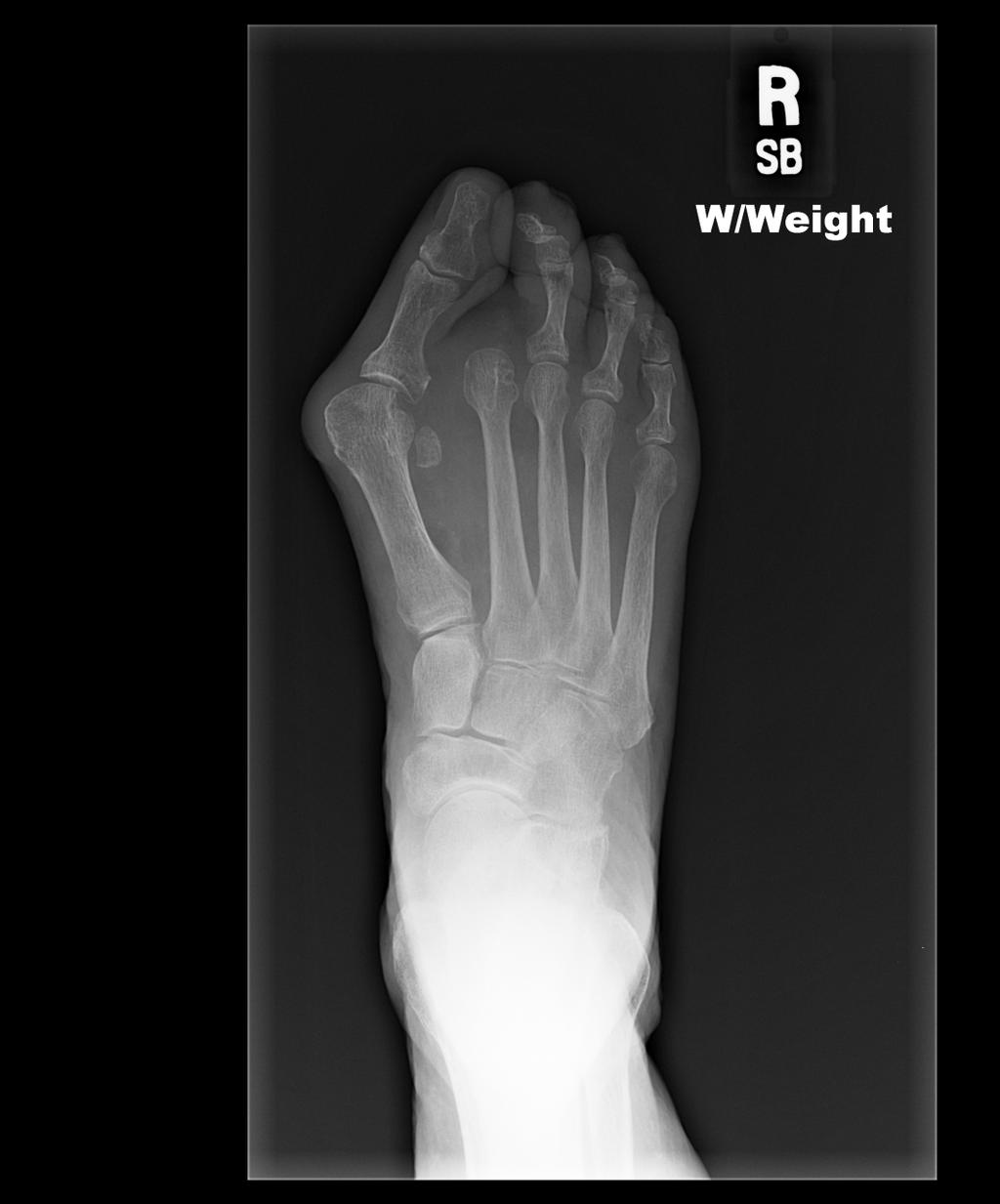 Lesser Toe Amputations Removal of distal phalanx is ideal Disarticulation at 2 nd MTPJ