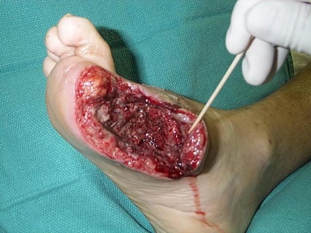 1 st Ray Amputation Preserve as much length of the metatarsal as possible Preserves the medial