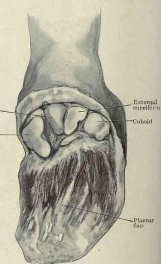 Tarsometatarsal Amputations Results in a major loss of forefoot lever Prone to equinus Must