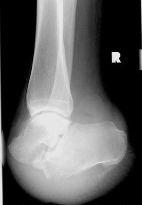 Chopart s Amputation Equinus contracture is the major drawback Must lengthen Achilles