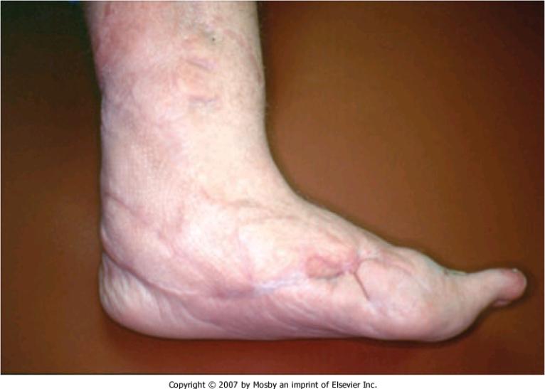 Goals of PFA Plantigrade foot Stable wound healing Prevent future ulceration