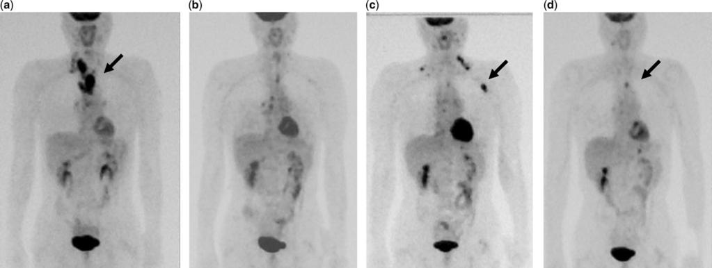 Jpn J Clin Oncol 2007;37(4) 317 Figure 2. 18 F-fluorodeoxy-D-glucose positron emission tomography in case 4.