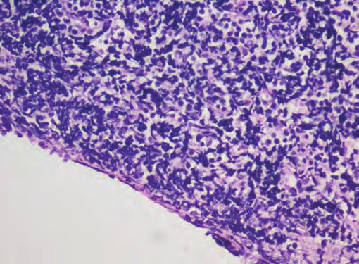Scrape, imprint cytology, biopsy of all specimens, and bone marrow aspirate showed features which were suggestive of non-hodgkin lymphoma-burkitt type.