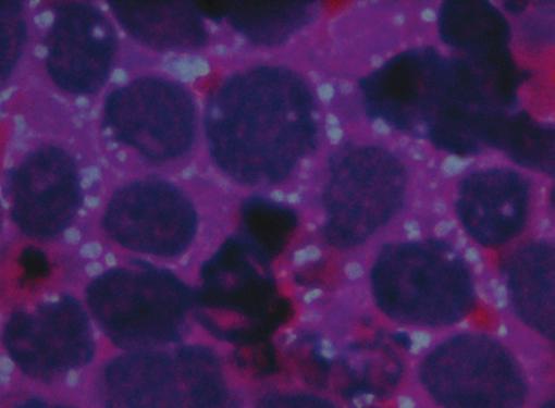 cells with nuclear and cytoplasmic vacuolations. Giemsa (40 ) Fig.