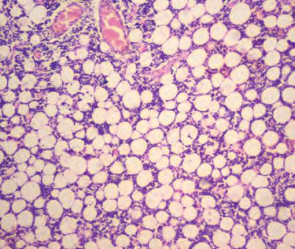 7: Ovarian tissue showing diffuse infiltrate of atypical lymphoid  