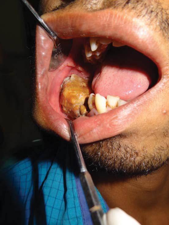The condition started with a mild, dull, and intermittent pain in this tooth region, which regressed after taking medication; this was followed by a small asymptomatic swelling that gradually