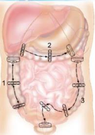 Iliac Fossa Terminal ileum and appendix Jejunum Crohn s Disease