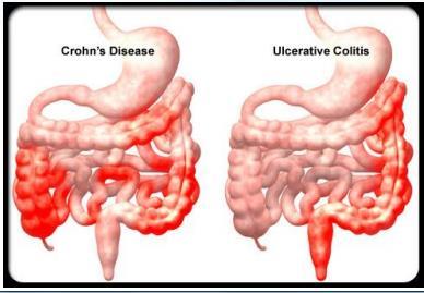 Bowel Inflammation Can affect any part of the GI tract Ileocaecal (45%) Terminal