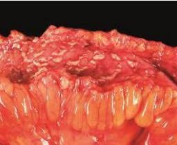 gastroduodenal (5%) Crohn s Disease Chronic relapsing inflammatory condition