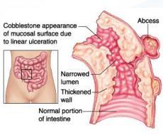 Diagnostic Features Crohn s Disease Mural thickening Mesenteric fat wrapping Ulceration - Apthous -Fissures - Cobblestoning Skip