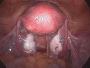 Uterus Fundus Bulging upper part of the uterus Body The body is the middle