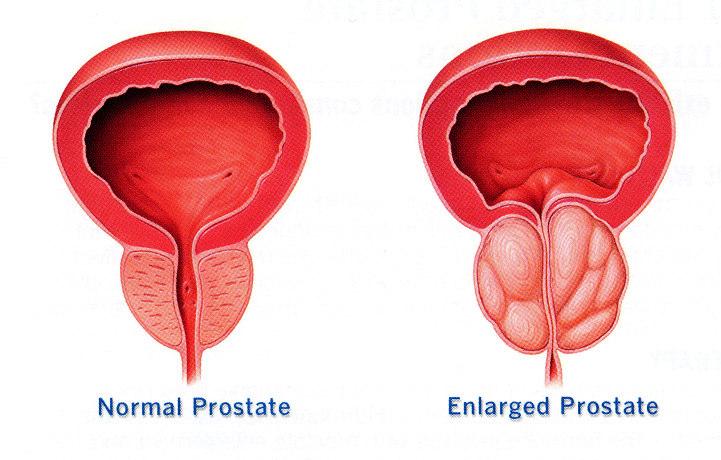 The majority of this information sheet explains the causes in men due to the frequency of the condition being caused by an enlarged prostate only present in men.