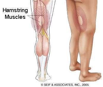 Diagnosis: Hamstring Muscle Syndrome What is Hamstring Muscle Syndrome? The hamstrings are the muscles running down the back of the thighs.
