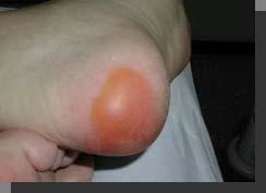 an intact or open/ruptured serum-filled or sero-sanginous filled blister.