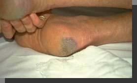 adjacent tissue. Deep tissue injury may be difficult to detect in individuals with dark skin tones.